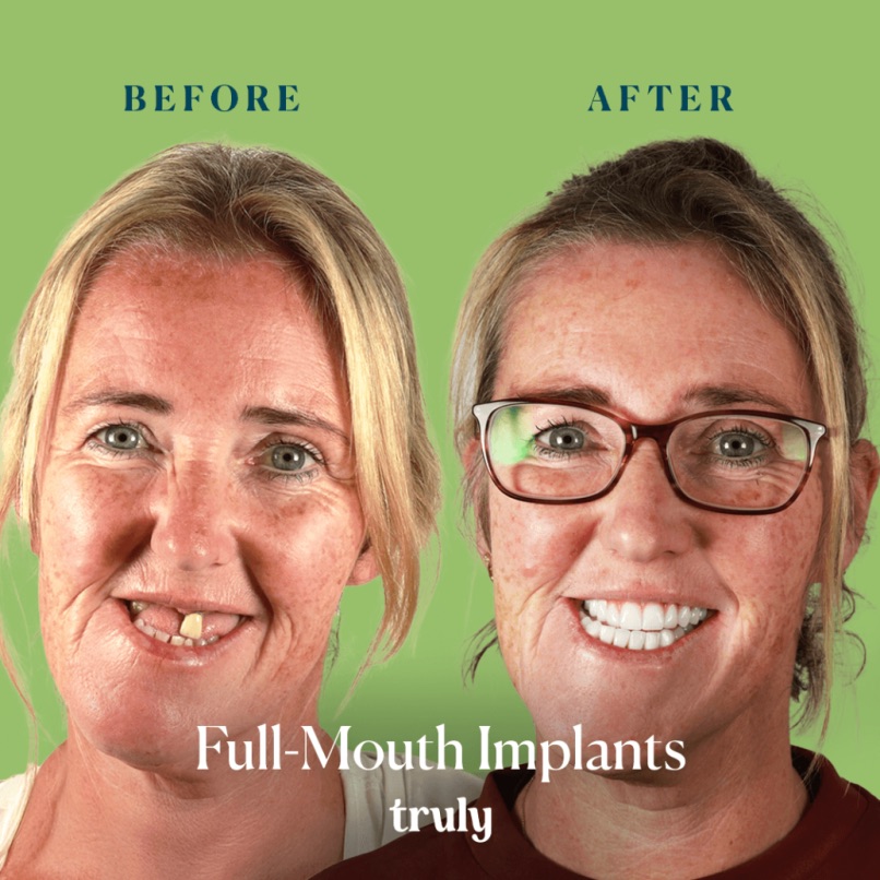 Before and after full mouth implants, Truly patient 1