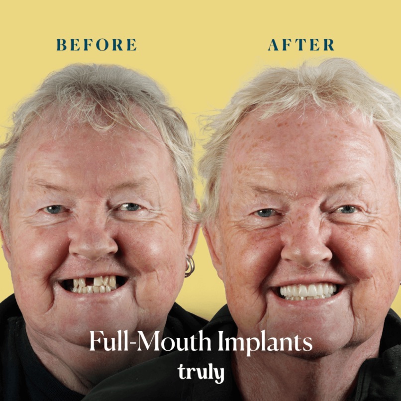 Before and after full mouth implants, Truly patient 2