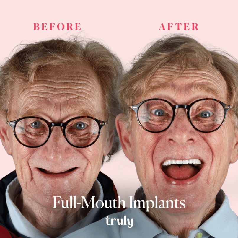 Before and after full mouth implants, Truly patient 3