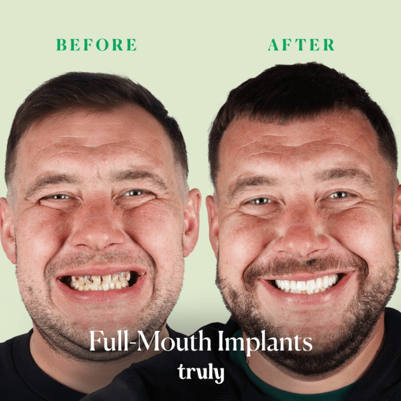 Before and after full mouth implants, Truly patient 4