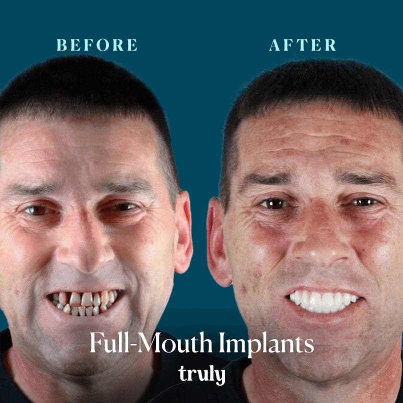 Before and after full mouth implants, Truly patient 5