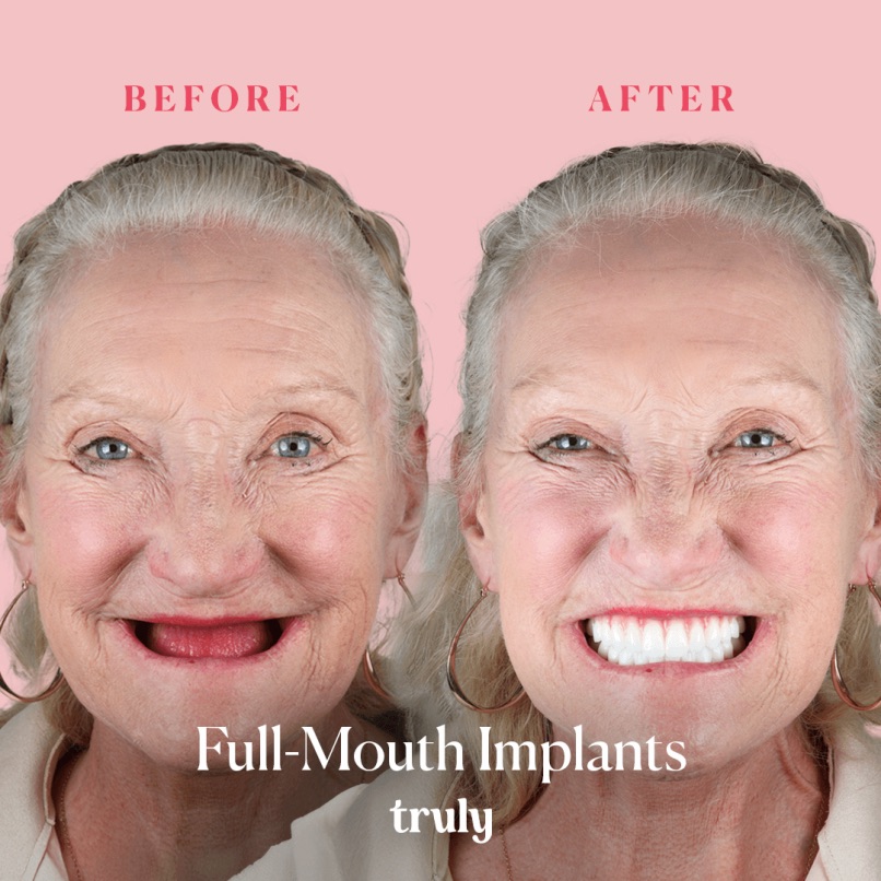 Before and after full mouth implants, Truly patient 6