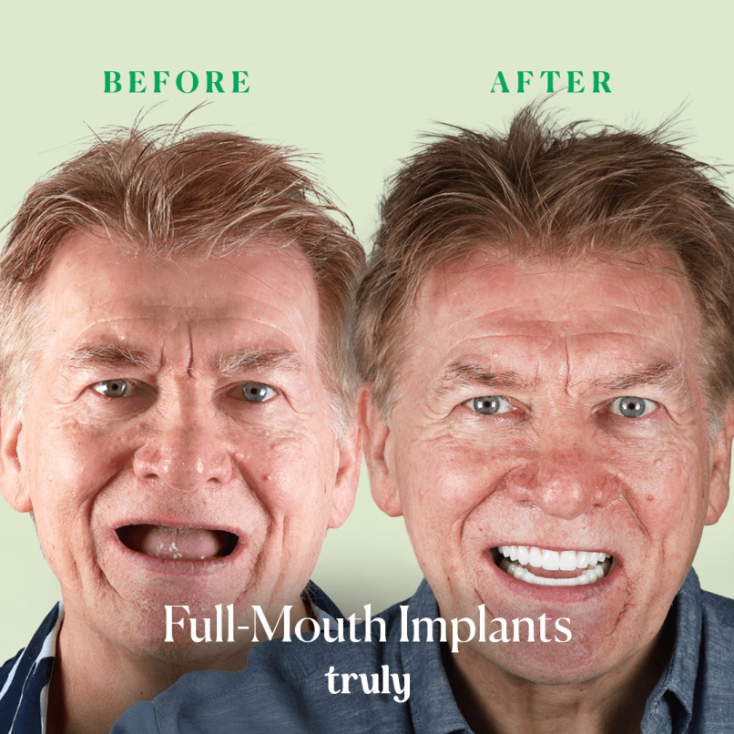 Before and after full mouth implants, Truly patient 7