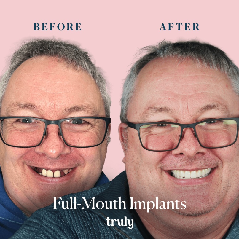 Before and after full mouth implants, Truly patient 8