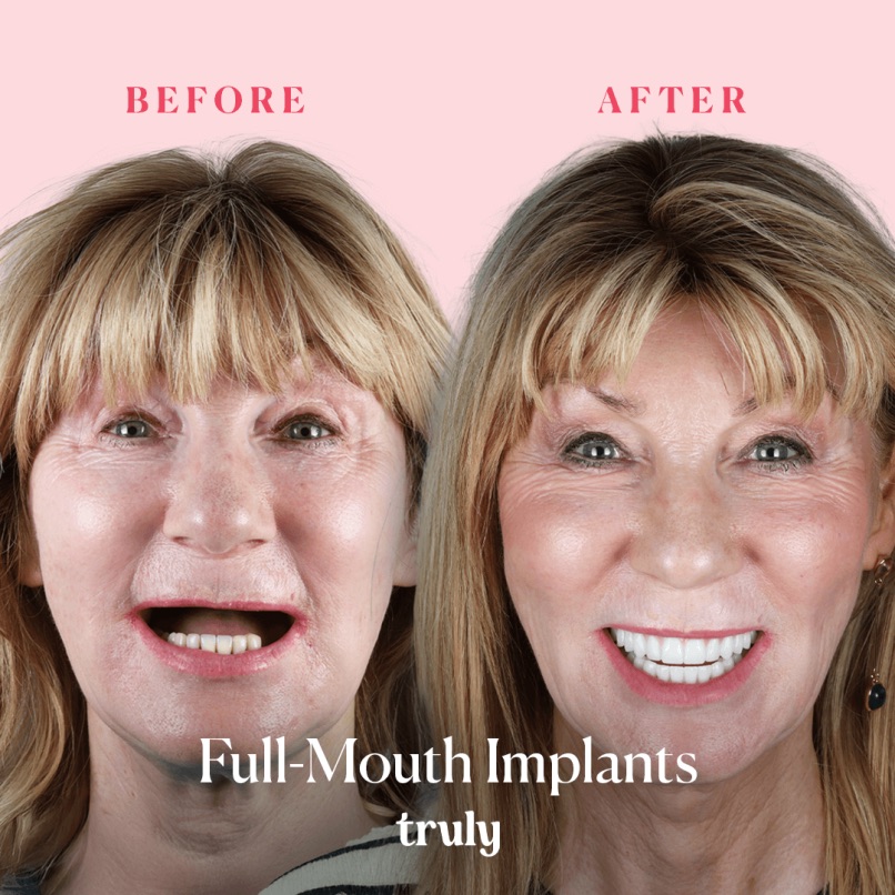 Before and after full mouth implants, Truly patient 9