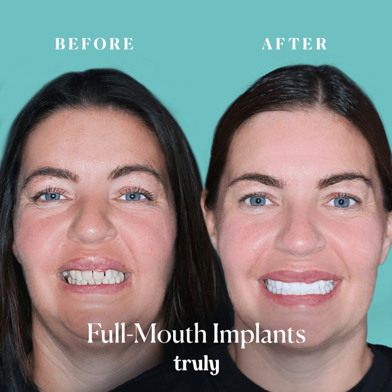 Before and after full mouth implants, Truly patient 10
