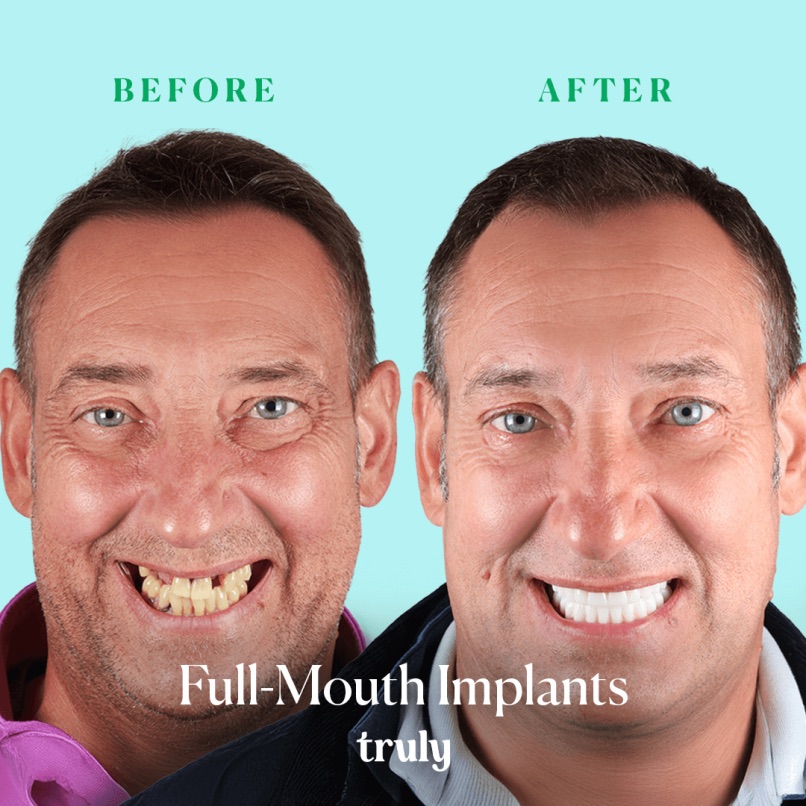 Before and after full mouth implants, Truly patient 11