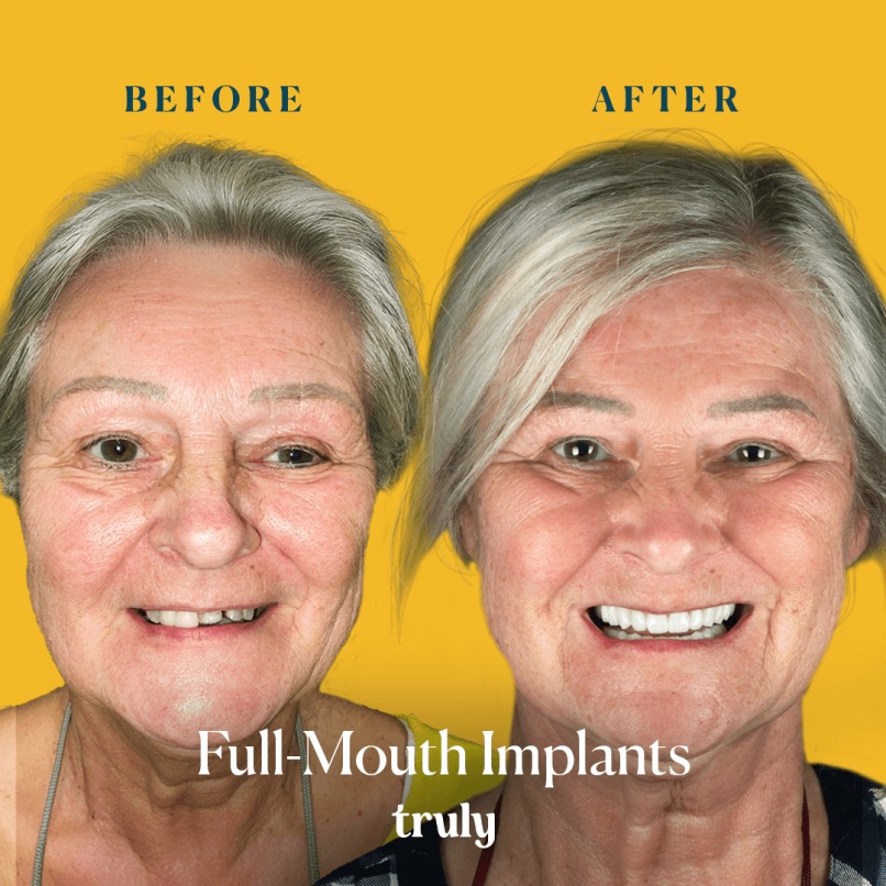 Before and after full mouth implants, Truly patient 12