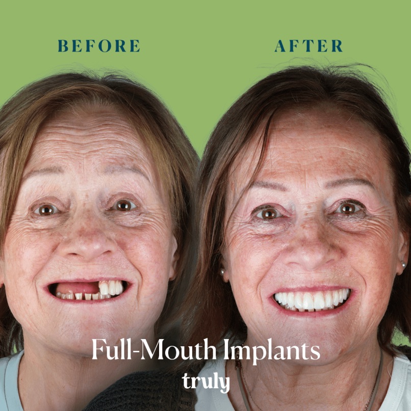 Before and after full mouth implants, Truly patient 13