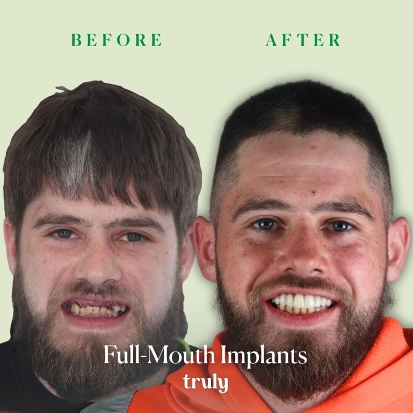 Before and after full mouth implants, Truly patient 14
