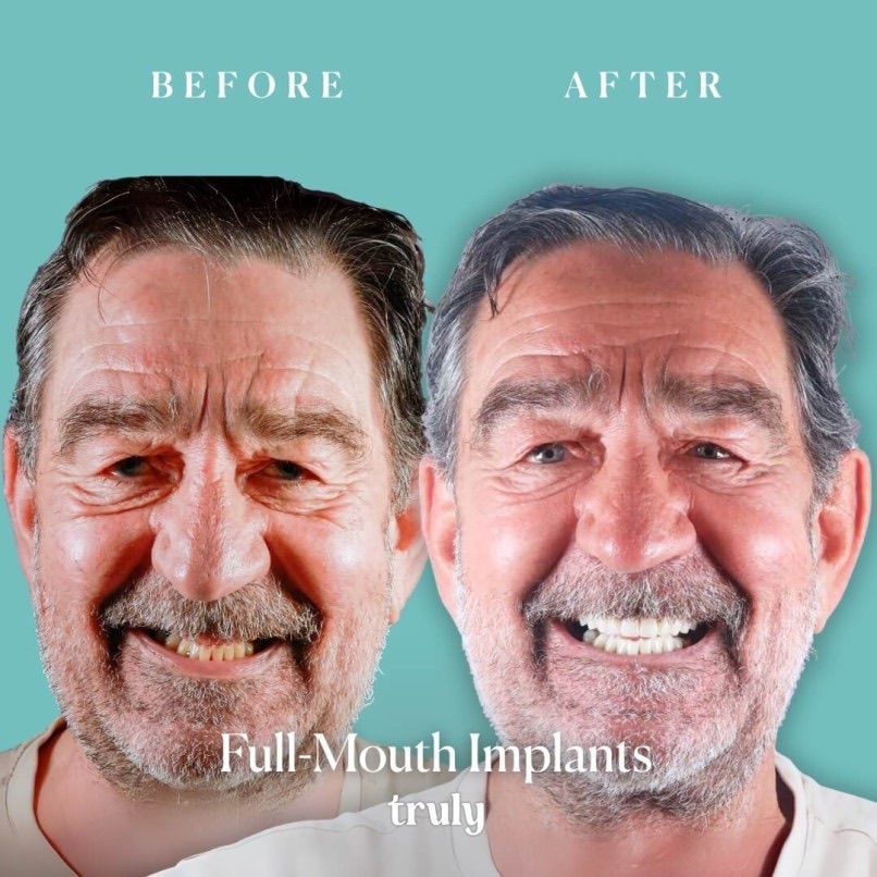 Before and after full mouth implants, Truly patient 15