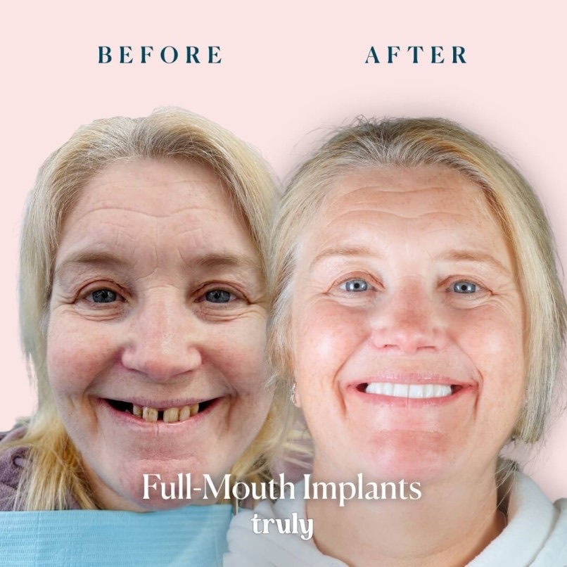Before and after full mouth implants, Truly patient 16