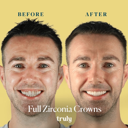 Before and after composite bonding at Truly, case 1