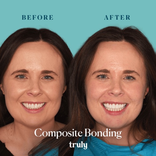Before and after composite bonding at Truly, case 2