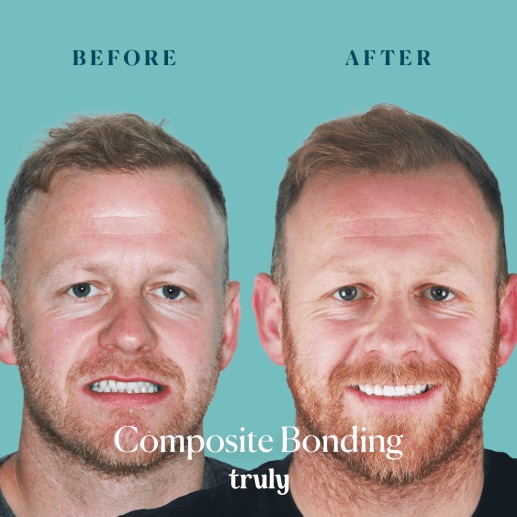 Before and after composite bonding at Truly, case 3