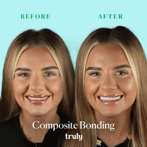 Before and after composite bonding at Truly, case 4