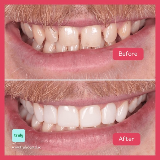 Before and after composite bonding at Truly, case 5