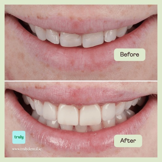 Before and after composite bonding at Truly, case 6