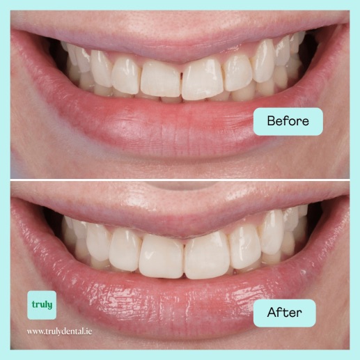 Before and after composite bonding at Truly, case 7