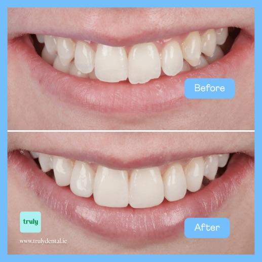 Before and after composite bonding at Truly, case 8