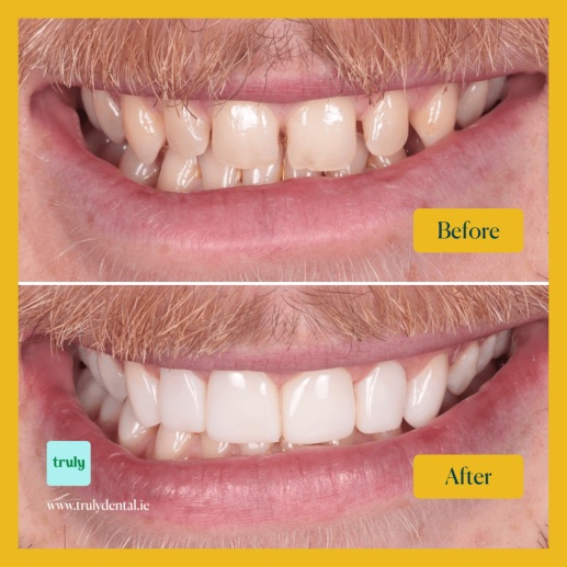 Before and after composite bonding at Truly, case 9