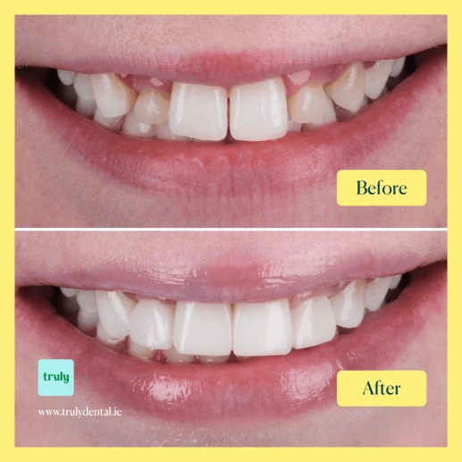 Before and after composite bonding at Truly, case 10