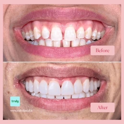 Before and after composite bonding at Truly, case 11
