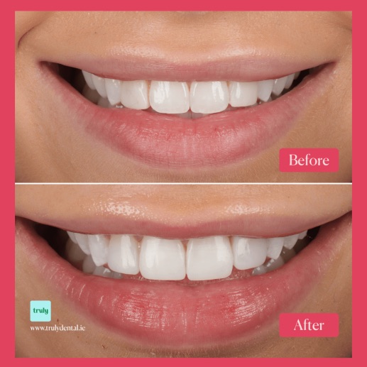 Before and after composite bonding at Truly, case 12