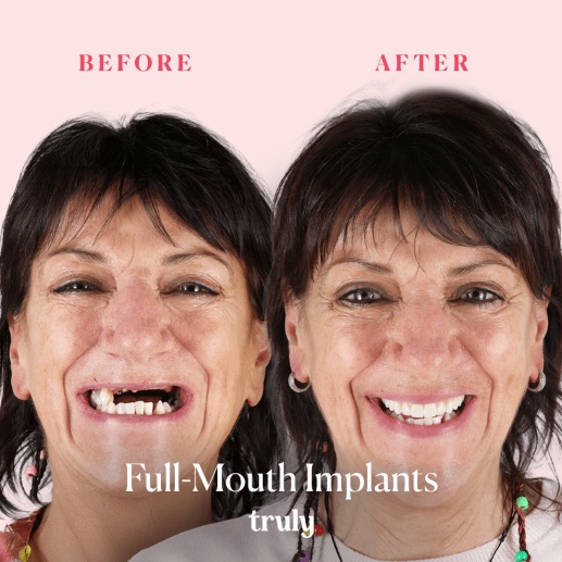 Before and after dental implants at Truly, case 1