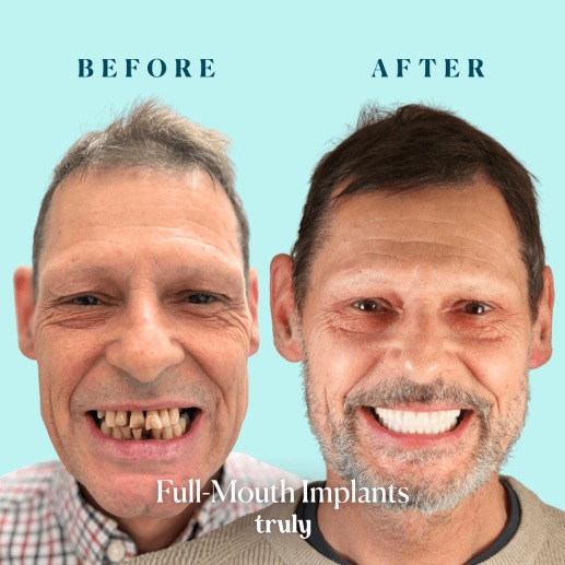 Before and after dental implants at Truly, case 2