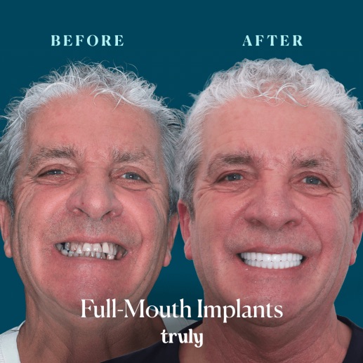 Before and after dental implants at Truly, case 3