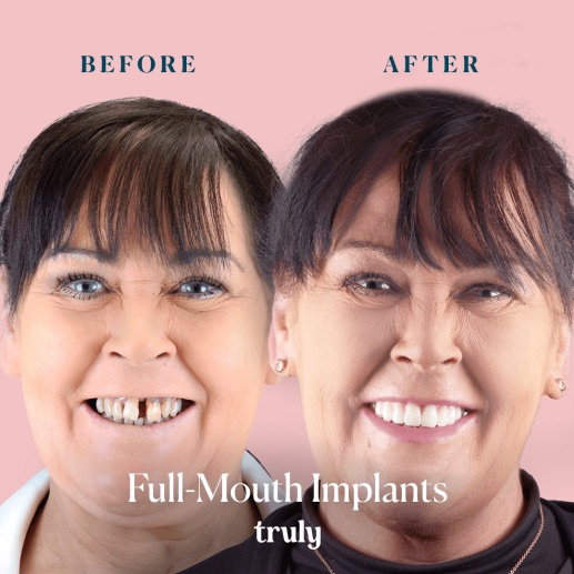 Before and after dental implants at Truly, case 4