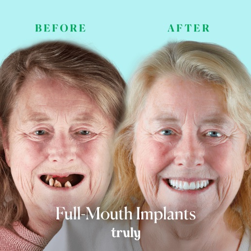 Before and after dental implants at Truly, case 5