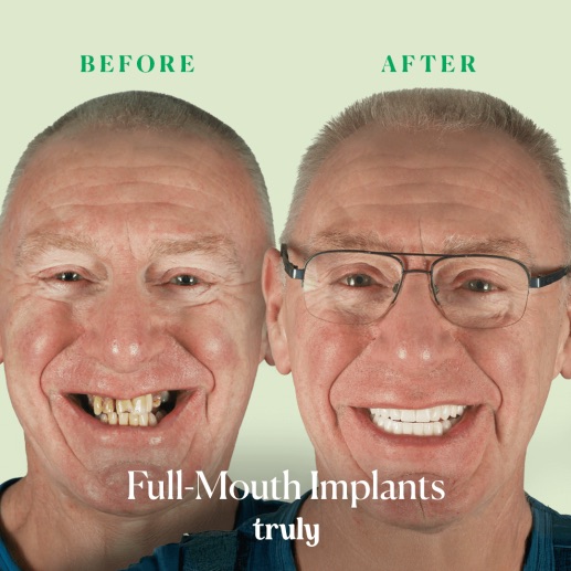 Before and after dental implants at Truly, case 6