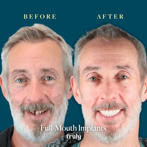 Before and after dental implants at Truly, case 7