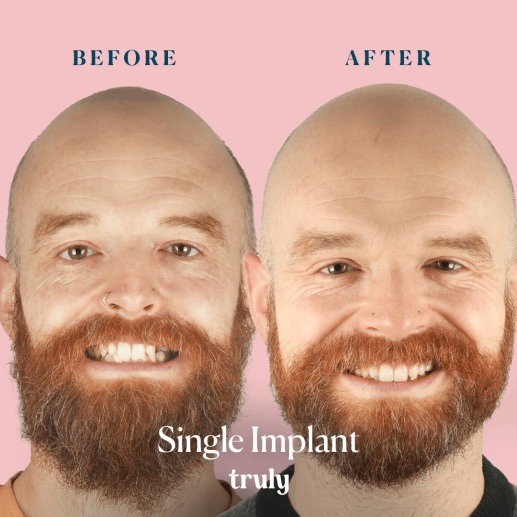 Before and after dental implants at Truly, case 8