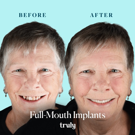 Before and after dental implants at Truly, case 9