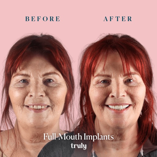 Before and after dental implants at Truly, case 10