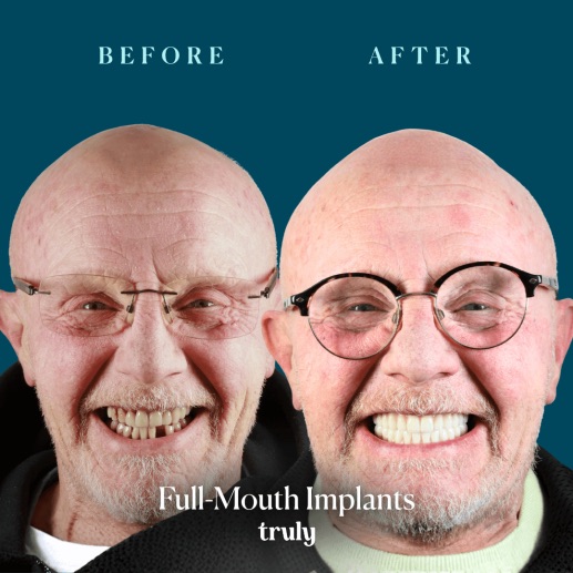 Before and after dental implants at Truly, case 11