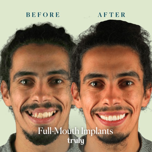 Before and after dental implants at Truly, case 12
