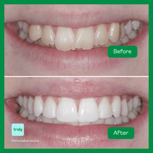 Before and after invisalign & braces at Truly, case 1
