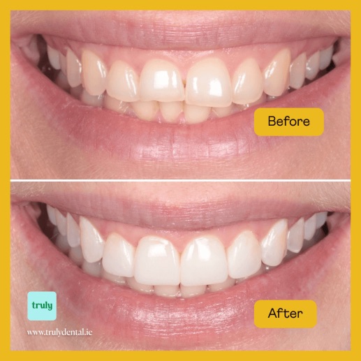 Before and after invisalign & braces at Truly, case 2