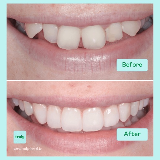Before and after invisalign & braces at Truly, case 3