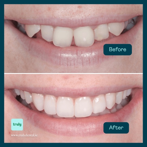Before and after invisalign & braces at Truly, case 4