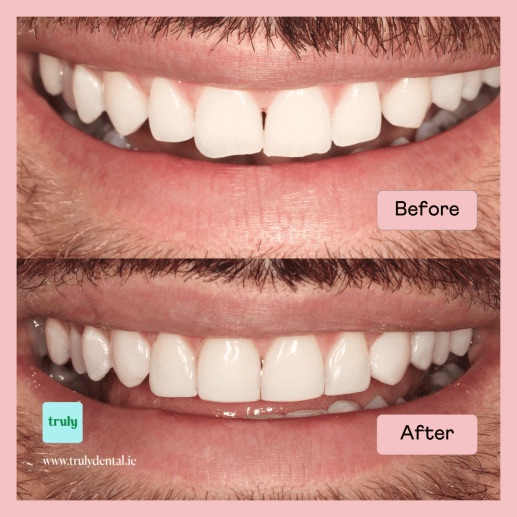 Before and after invisalign & braces at Truly, case 5