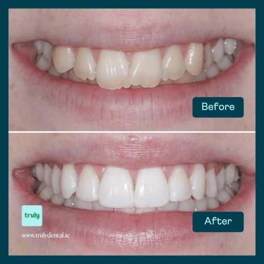 Before and after invisalign & braces at Truly, case 6