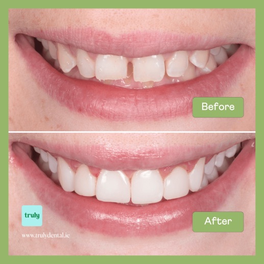 Before and after invisalign & braces at Truly, case 7