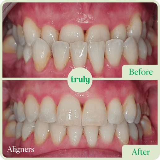 Before and after invisalign & braces at Truly, case 8