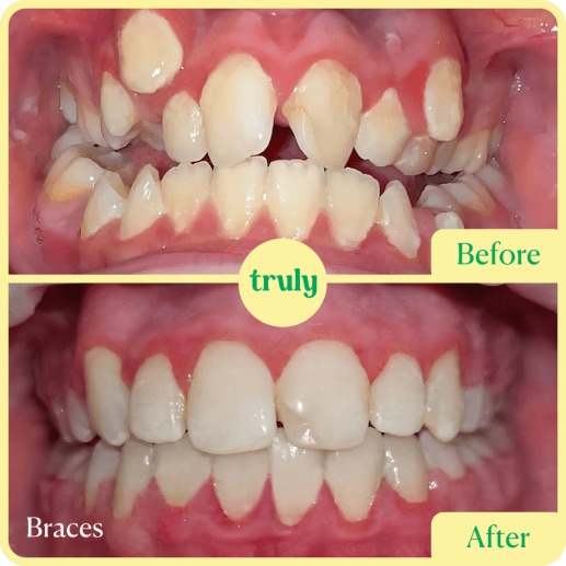 Before and after invisalign & braces at Truly, case 9