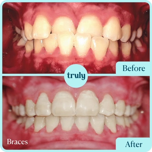 Before and after invisalign & braces at Truly, case 10